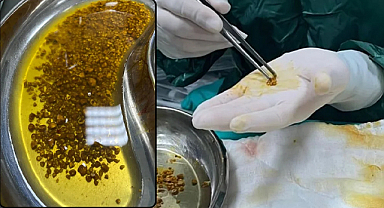 Doktorlar Bile Şaşırdı: Safra Kesesinden 2 Bin 67 Taş Çıktı