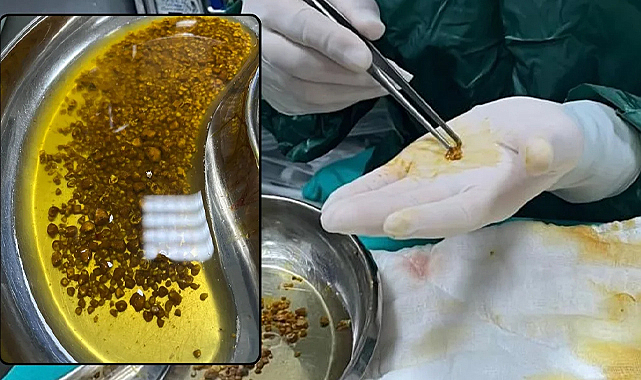 Doktorlar Bile Şaşırdı: Safra Kesesinden 2 Bin 67 Taş Çıktı