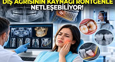 Diş Ağrısının Kaynağı Röntgenle Netleşebiliyor!