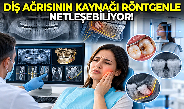 Diş Ağrısının Kaynağı Röntgenle Netleşebiliyor!